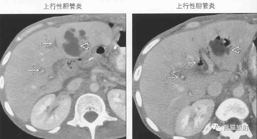 鑑別診斷丨肝門靜脈周透亮或水腫門靜脈周圍間隙增寬