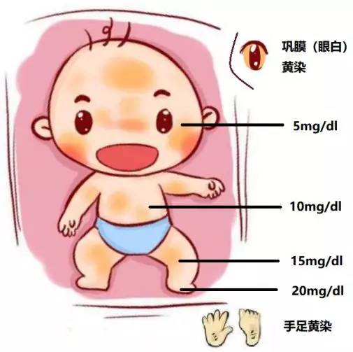 宝宝有黄疸为什么不能抱去晒太阳