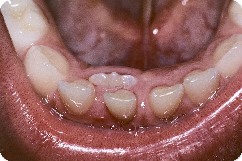 宝宝长牙会带来不适,牙龈红肿或者是低烧