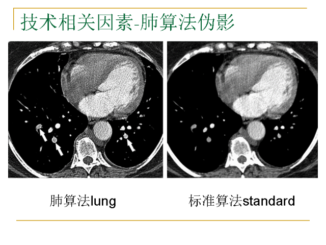 經典講座肺動脈栓塞cta