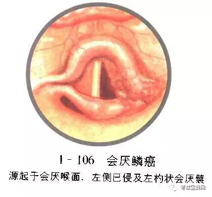 喉咙鳞状细胞癌图片