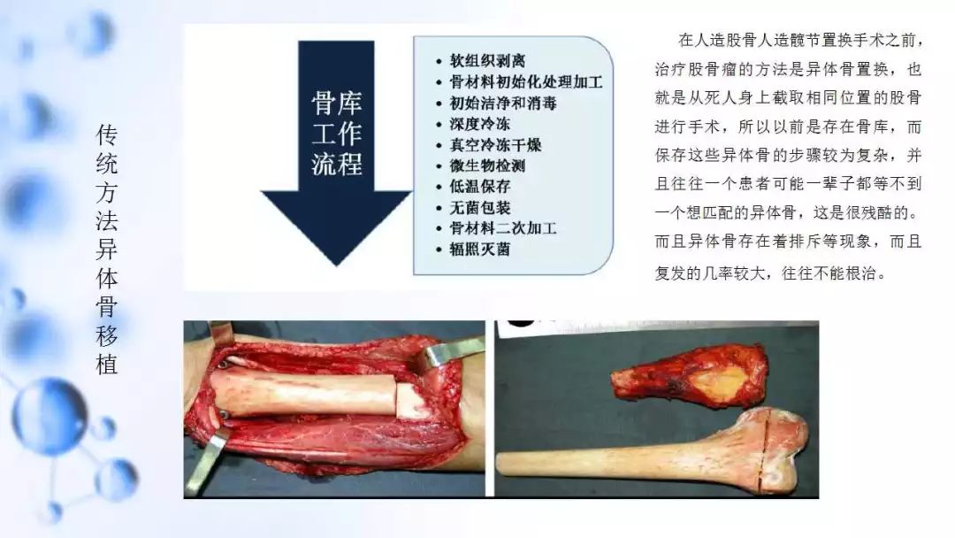 作品分享--股骨瘤——全髖節切除逆向輔助手術|數字工業