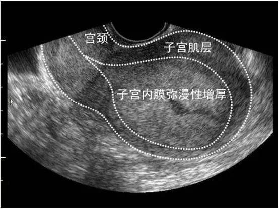 子宫内膜分层图片