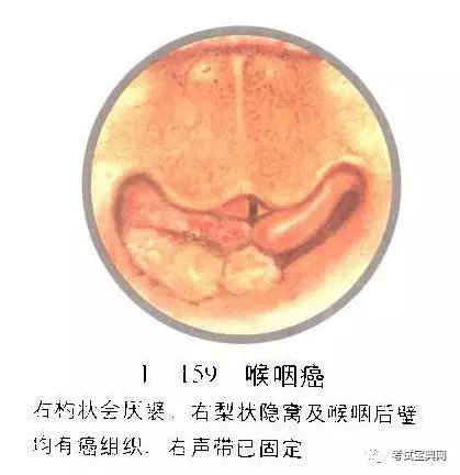 耳鼻喉科疾病圖譜一喉部疾病