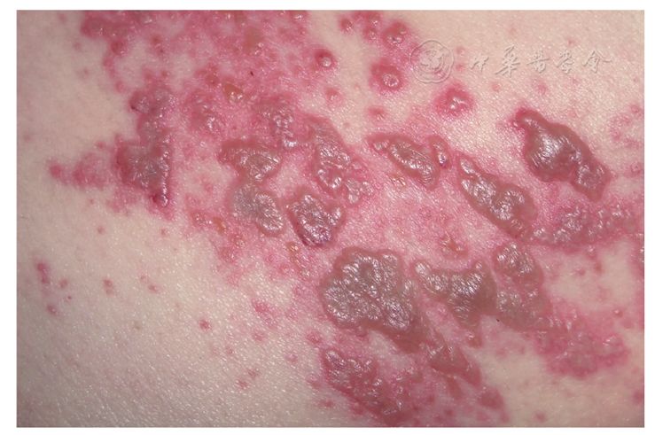 图3水痘(带状疱疹)表现出的水疱你应该做什么?