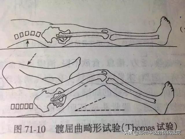 腰大肌挛缩试验图片