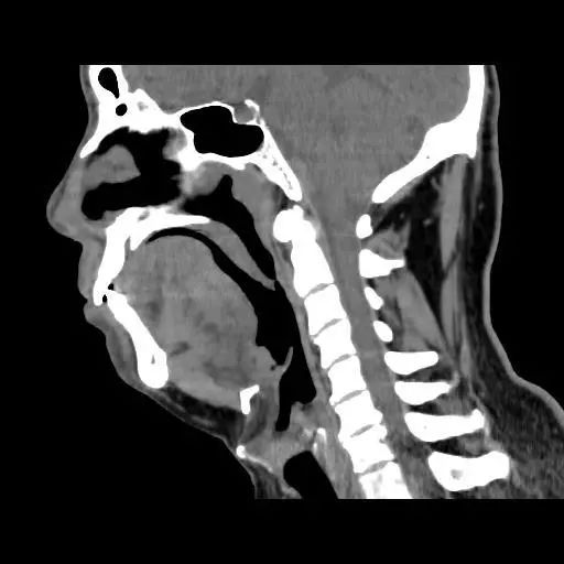 软腭CT解剖图片