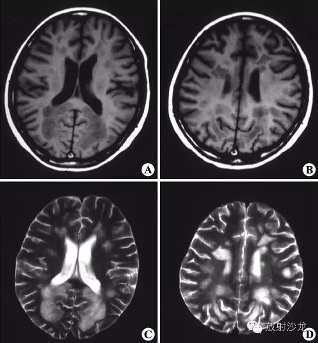 mri平扫示双侧侧脑室周围及深部脑白质多发斑片状异