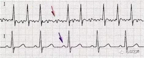 心房顫動心電圖(上)和正常竇性心律(下).