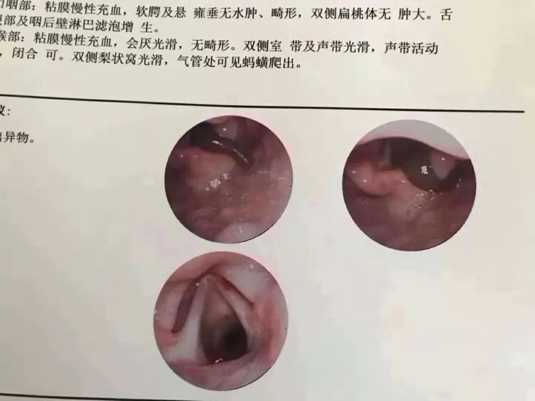 害怕怕大理州医院一男孩气管内取出8厘米长活蚂蟥