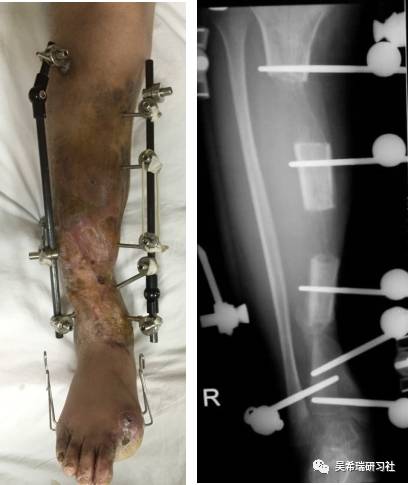 開放植骨 表面鱗片式骨水泥 多重脛蹠骨牽引技術 外固定架吳氏構型