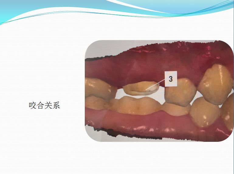 上頜第一恆磨牙dbmbmb2彎曲根管一次性根管治療及數字化冠修復第三屆