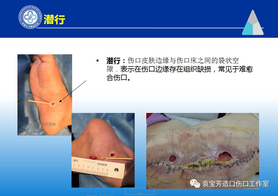 伤口潜行图片