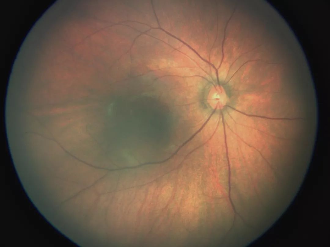 视网膜母细胞瘤影像图片