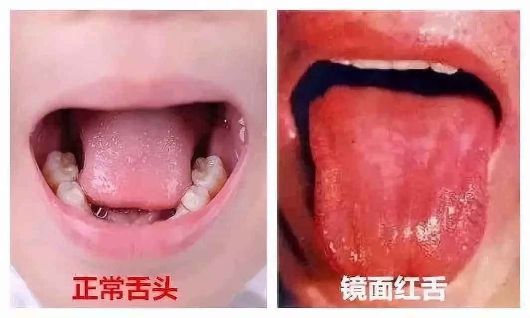 正常小孩的舌头图片图片