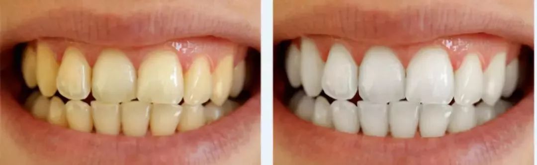 7天黄牙变白牙,德国牙医推荐,这款美白洁牙笔,牙渍一笔勾销!