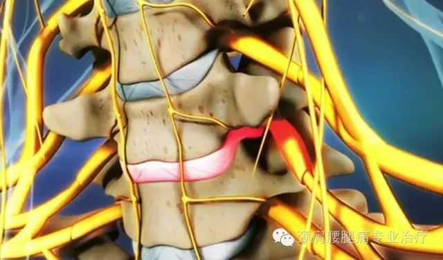 中英文字幕:頸椎間盤突出(cervical herniated disc)