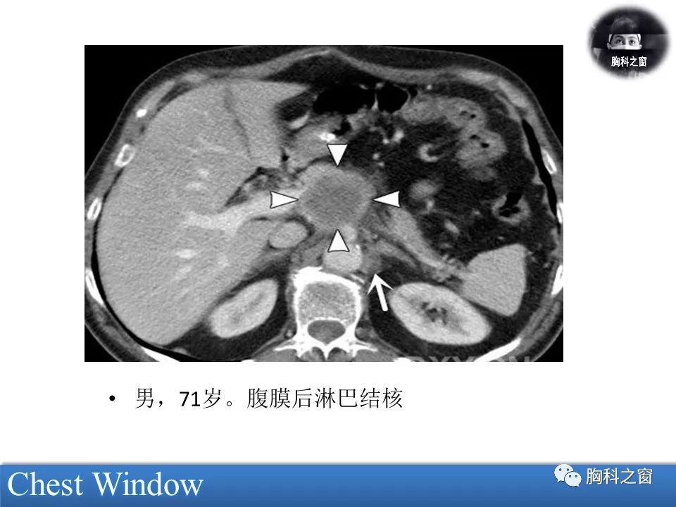 结核性腹膜炎CT图片