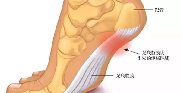 筋膜炎疼痛位置图片图片