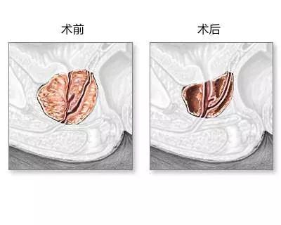 【健康大講堂】前列腺疾病不用愁,醫生妙招破