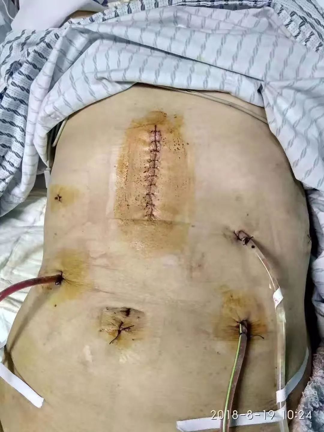胃癌手术刀疤图片图片