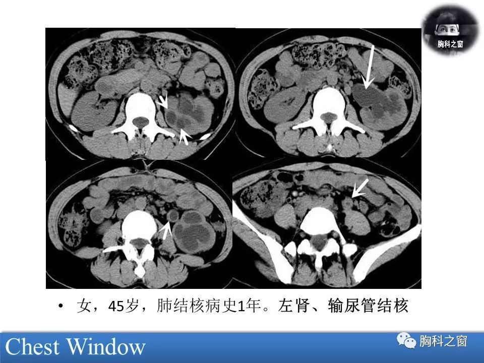 结核性腹膜炎CT图片