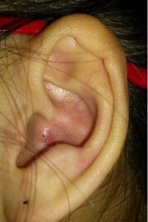 耳朵外耳轮有一个小洞图片