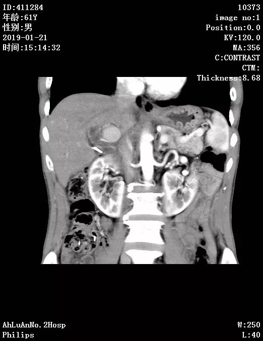 马蹄肾与正常肾图片图片