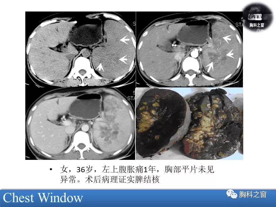 结核性腹膜炎CT图片