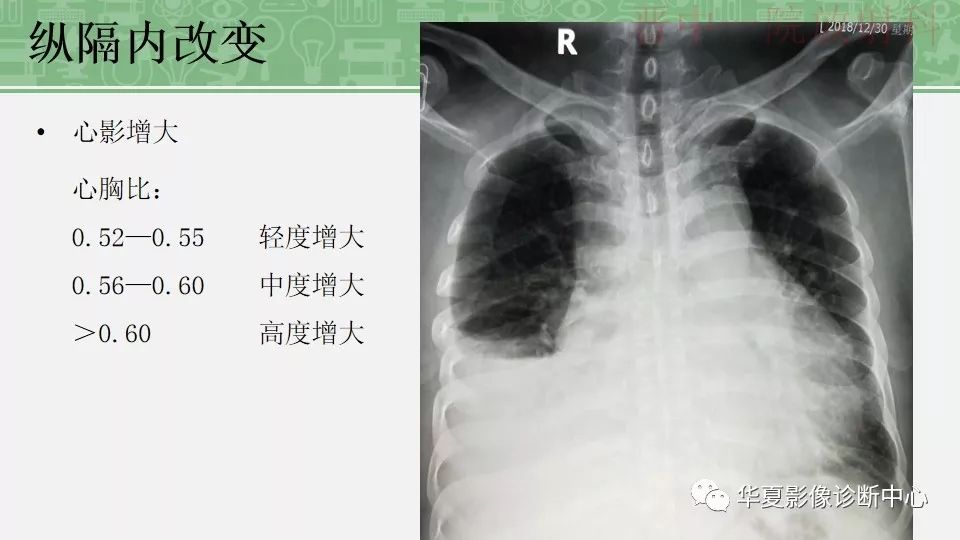 胸部常见疾病x线表现