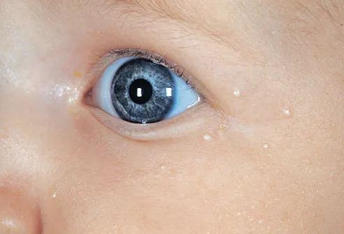 婴儿内眼睑白色颗粒图图片