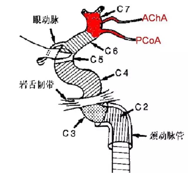 分支:后交通动脉(pcoa),脉络膜前动脉(acha)变异:从颈内动脉(ica)