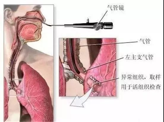 气管镜进镜技巧图解图片