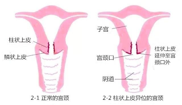 子宫体子宫颈位置图片