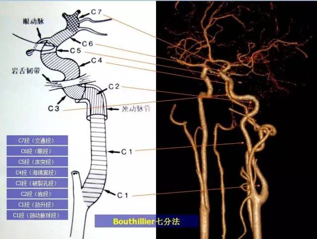 颈内动脉分为七段,见下图1