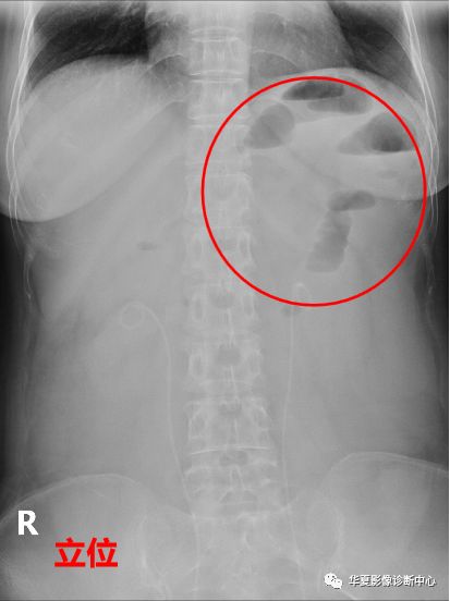 肠梗阻平片怎么看图片