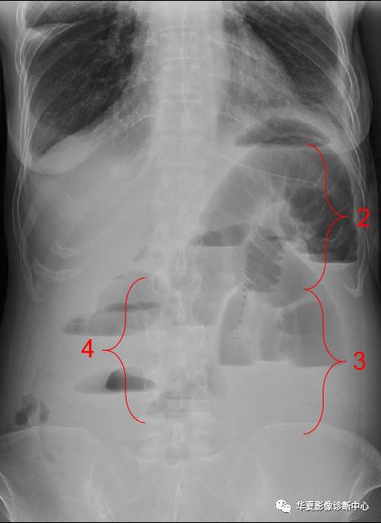 肠梗阻x线表现
