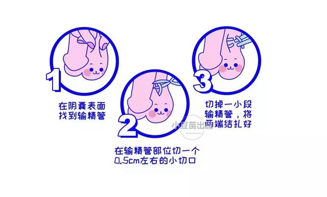 男人的结扎部位在输精管,通过切断输精管,阻止精子先生和卵子小姐的