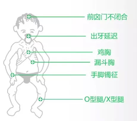 小孩鸡胸的症状图片