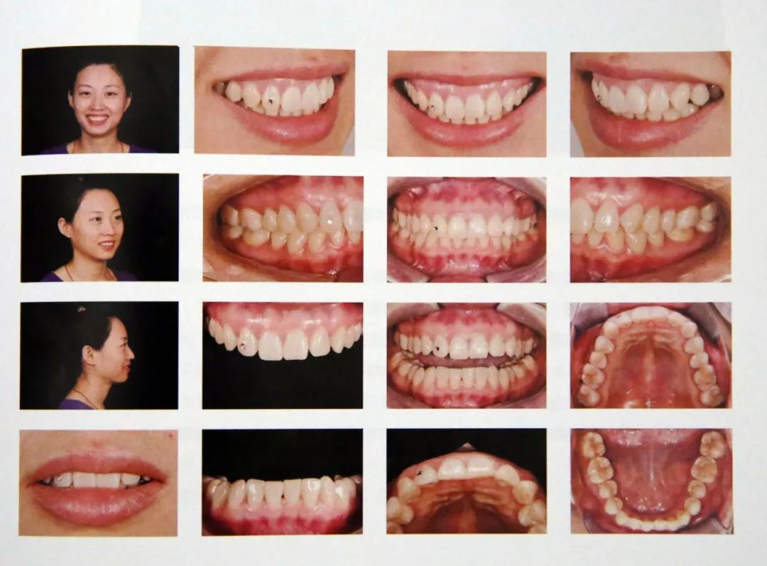图片资料来源于北京大学口腔医院刘峰老师的《口腔数码摄影》