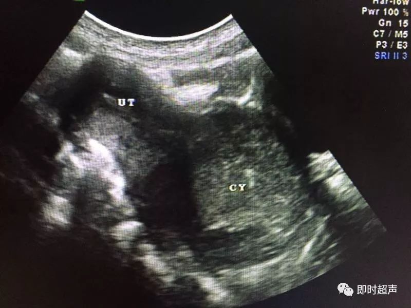 13岁女生月经未来潮——宫颈闭锁并阴道发育不良
