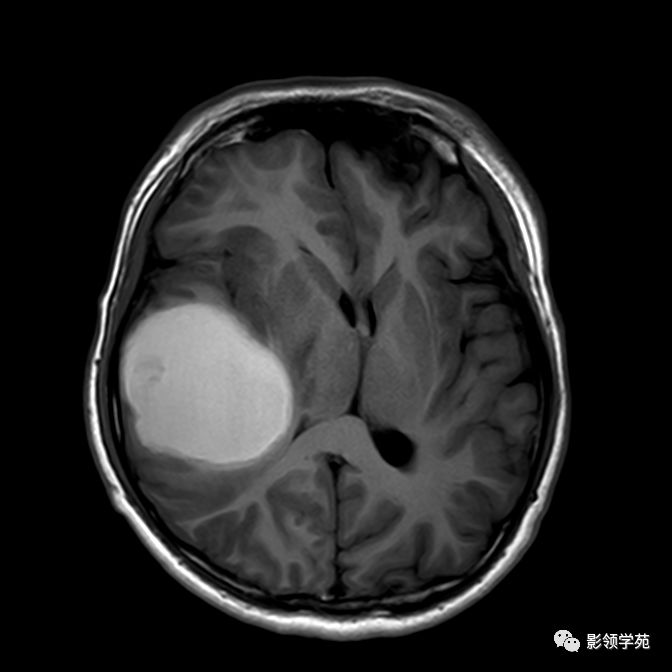 间断头痛双侧瞳孔正大等圆海绵状血管瘤伴出血