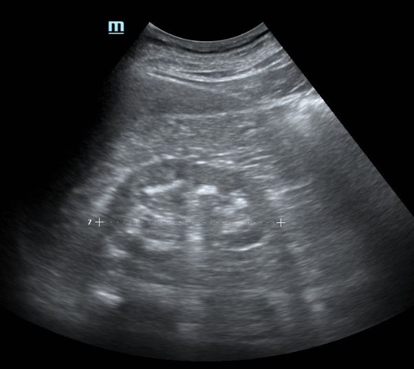 肾窦回声增强图片