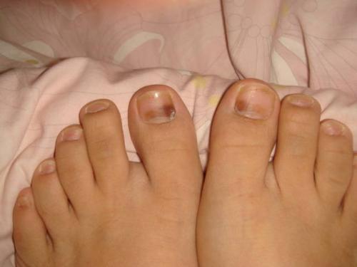 灰指甲症状早期图片