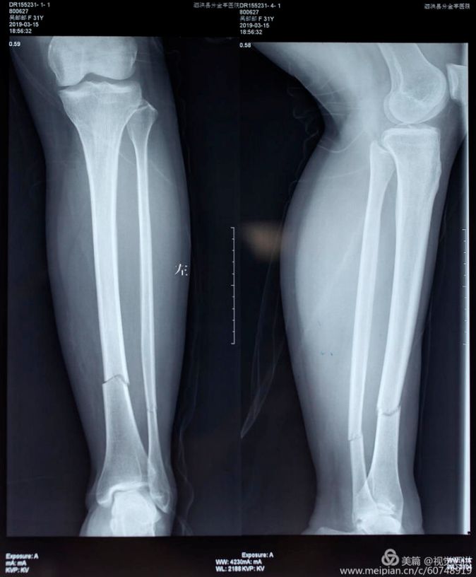 大腿骨折x光片图片图片