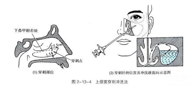 鼻子穿刺手术图片图片