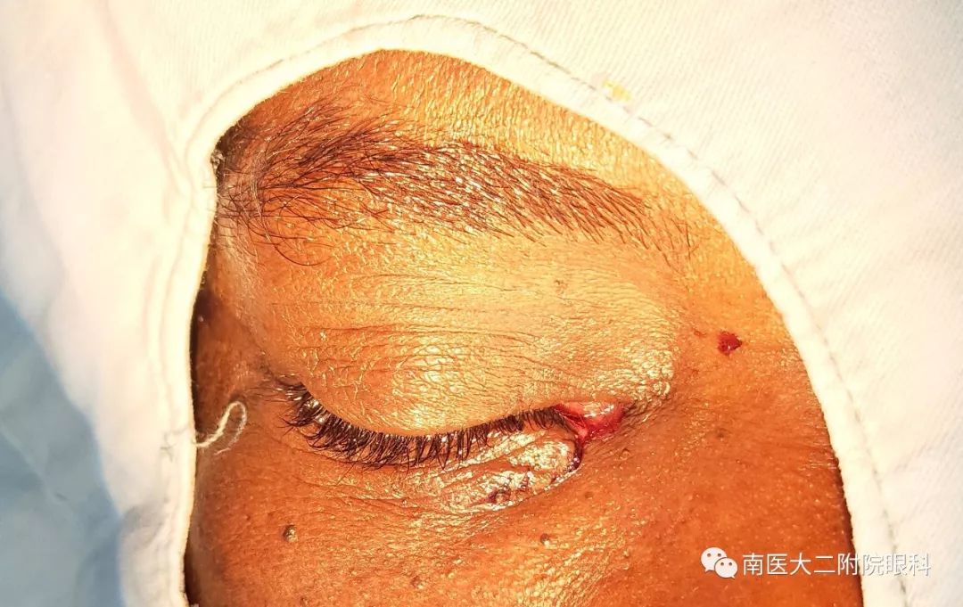 详细的检查,发现右眼内眦角全程裂伤,经诊断为右眼睑裂伤伴泪小管断裂