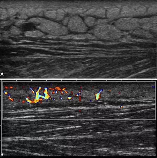 脂膜炎超声声像图图片