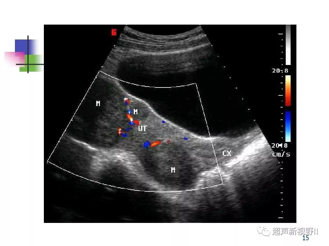 超声微课堂子宫疾病超声诊断