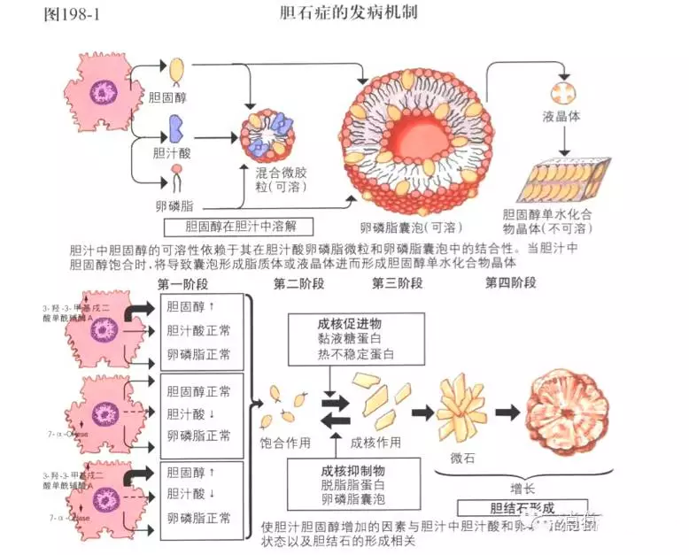 胆汁变得浓稠,容易诱发胆固醇析出,所以胆囊易形成结石